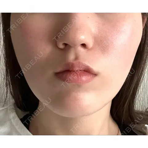 糸リフト / ハイフ（顔） EMMO FACE CLINIC 大宮院 DAY 0