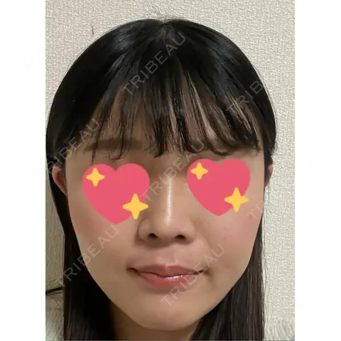 ピーリング（ニキビ・毛穴） ロナロナクリニック AFTER