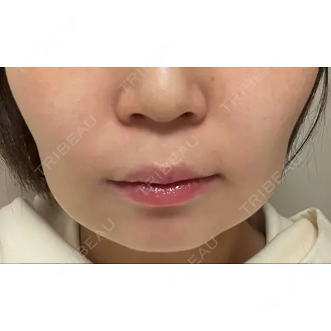 脂肪溶解注射（顔） AI Beauty Clinic （エーアイ美容クリニック） DAY 0