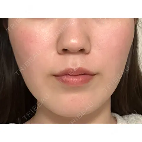 糸リフト / ハイフ（顔） EMMO FACE CLINIC 大宮院 AFTER