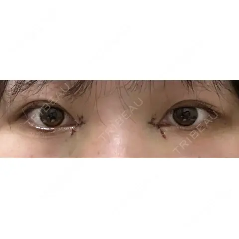 目頭切開 / ボトックス（額） AI Beauty Clinic （エーアイ美容クリニック） DAY 0