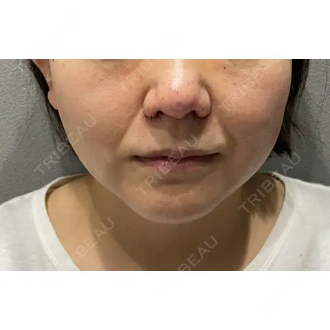鼻尖形成（切開） / 小鼻縮小（切開） / 鼻尖縮小 YBC横浜美容外科 大宮院 DAY 0