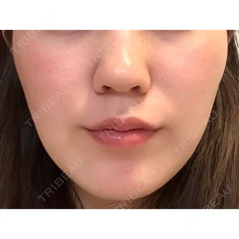 糸リフト / ハイフ（顔） EMMO FACE CLINIC 大宮院 AFTER