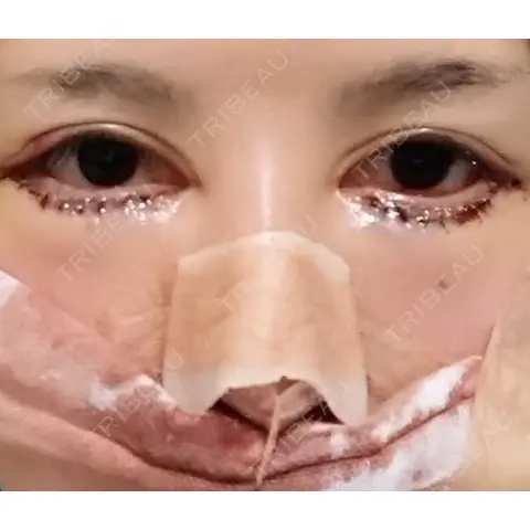 鼻尖形成（切開） / 鼻中隔延長（切開） / タレ目形成・グラマラスライン（切開） / 軟骨移植 / 鼻翼挙上 / 鼻孔縁挙上 / 鼻柱下降・鼻唇角形成（猫手術） / ボトックス（あご） / その他（鼻） 大阪TAクリニック DAY 1