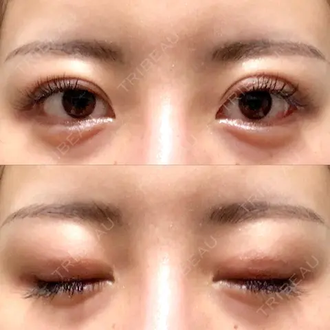 二重切開 ルネッサンス美容外科医院 青山本院 AFTER