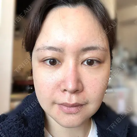 レーザートーニング（美白・肝斑） アクトリー勝どきウェルネスメディカルクリニック AFTER