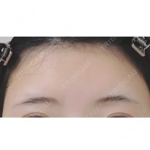 脂肪吸引（脚） / 脂肪注入（額） 藤・ナチュレ美容クリニック 銀座院 AFTER