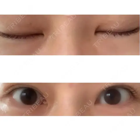 二重埋没 / 自然癒着法 ブルームクリニック（BLOOM CLINIC） AFTER