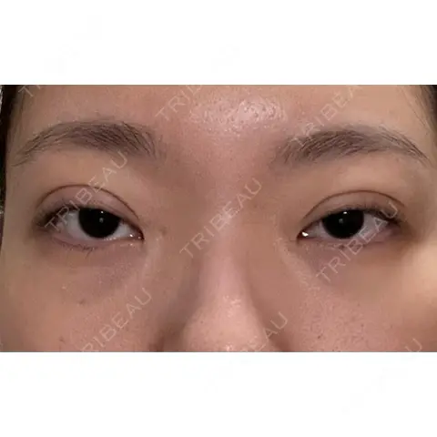 二重埋没 / ボトックス（口角） / ボトックス（人中） / ボトックス（ガミースマイル） AI Beauty Clinic （エーアイ美容クリニック） DAY 0