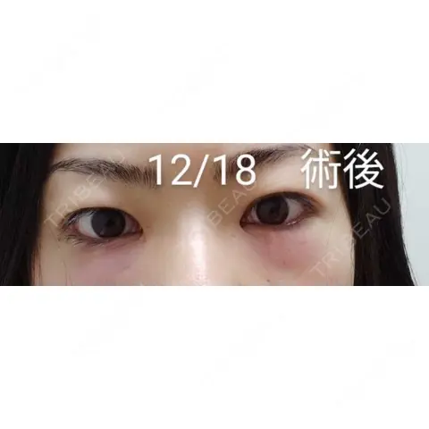 クマ治療 / 下まぶたたるみ取り / 下まぶたの脂肪取り TCB東京中央美容外科 宇都宮院 DAY 0