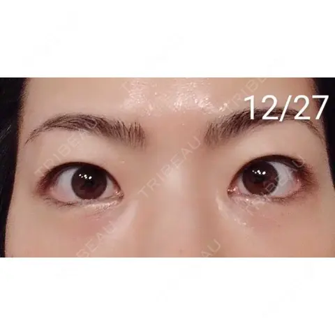 クマ治療 / 下まぶたたるみ取り / 下まぶたの脂肪取り TCB東京中央美容外科 宇都宮院 AFTER