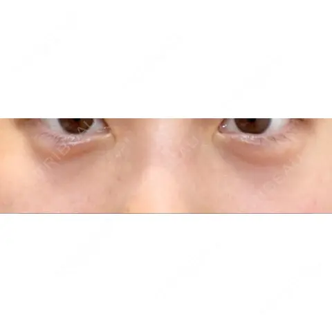 ヒアルロン酸注入（涙袋） 渋谷美容外科クリニック 新橋院 AFTER