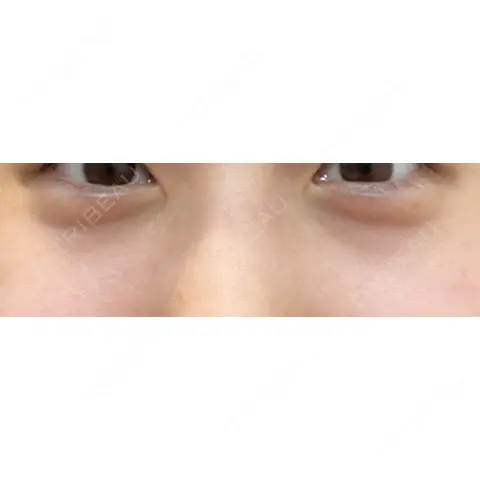 ヒアルロン酸注入（涙袋） 渋谷美容外科クリニック 新橋院 AFTER