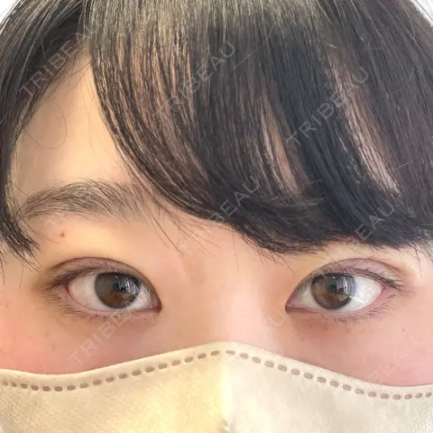 二重埋没 NARU Beauty Clinic 【ナルクリ】 DAY 0