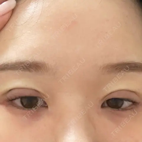 二重埋没 NARU Beauty Clinic 【ナルクリ】 DAY 0