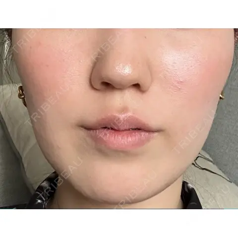 糸リフト / ハイフ（顔） EMMO FACE CLINIC 大宮院 AFTER