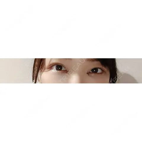 目頭切開 / クマ治療 HAAB×DREAM BEAUTY CLINIC 東京本院 DAY 0