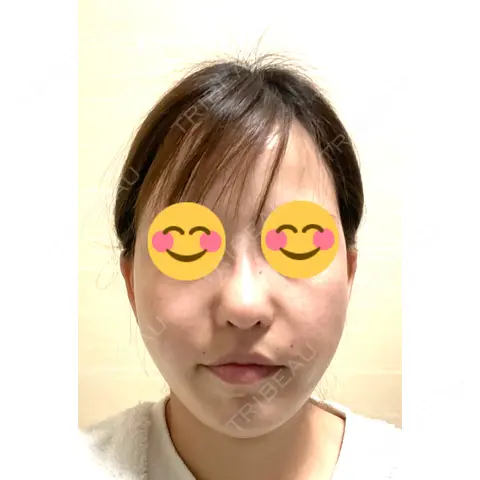 再生医療 TCB東京中央美容外科 銀座有楽町院 DAY 0