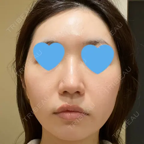 ポテンツァ LOUIS CLINIC 二子玉川院【ルイクリニック】 AFTER