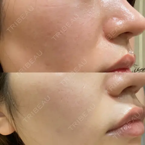 ポテンツァ LOUIS CLINIC 二子玉川院【ルイクリニック】 AFTER