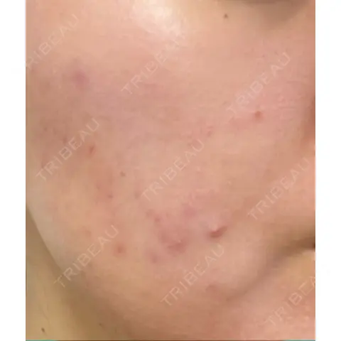 ポテンツァ LOUIS CLINIC 二子玉川院【ルイクリニック】 AFTER
