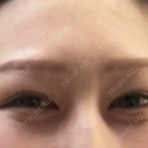 上まぶたの脂肪取り / 美容点滴・美容注射（美肌） / 美容点滴・美容注射（疲労回復） HAAB×DREAM BEAUTY CLINIC 大阪梅田院 AFTER