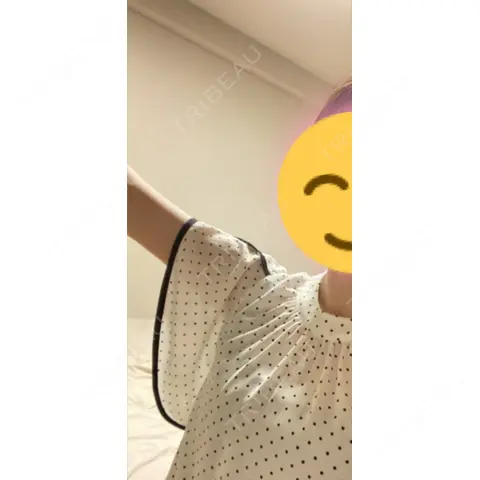 脂肪吸引（二の腕） 湘南美容クリニック 千葉センシティ院 AFTER