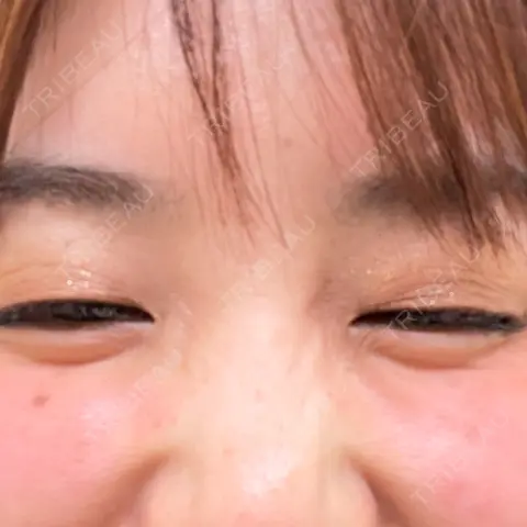 その他（目元） ももスキンケアクリニック DAY 0