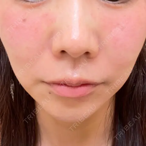 シミ取りレーザー ももスキンケアクリニック DAY 0