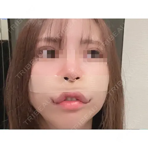 人中短縮 / 口角挙上 Venus beauty clinic 新宿院 DAY 0