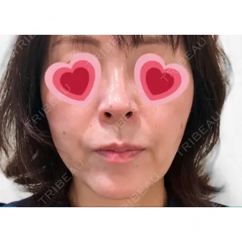 ハイフ（顔） オーキッド美容クリニック東京御徒町 DAY 0