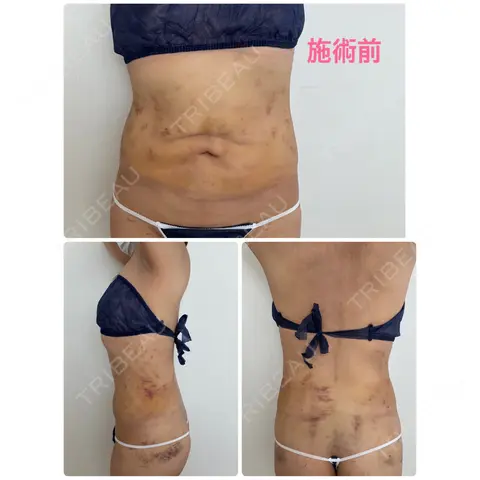 インディバ（お腹） / インディバ（腰） Medical Indiba Salon KMK【脂肪吸引後ダウンタイム専門サロン】 DAY 0