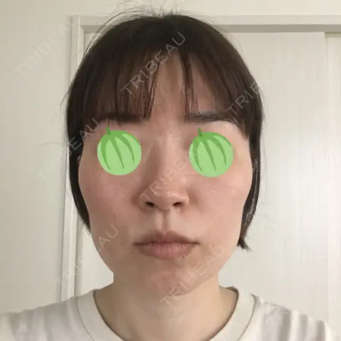 ボトックス（エラ・小顔） AI Beauty Clinic （エーアイ美容クリニック） DAY 0