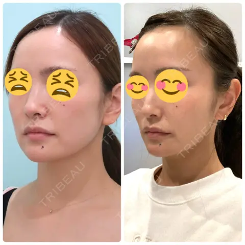 脂肪吸引（顔） / 輪郭修正 / ジョールファット除去 / 脂肪注入（輪郭） WOM CLINIC GINZA （ワム クリニック ギンザ） AFTER