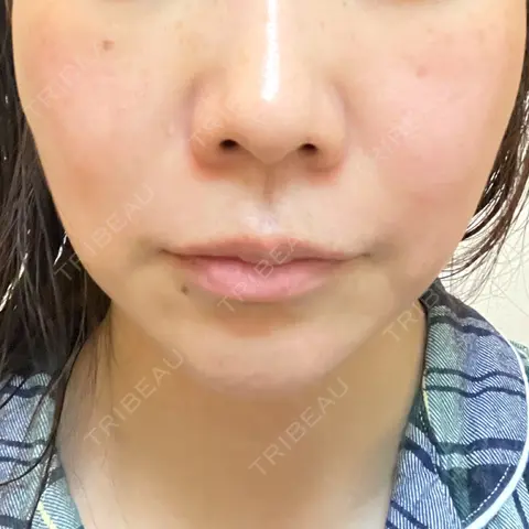 糸リフト / 脂肪吸引（顔） 湘南美容クリニック 岡山院 AFTER