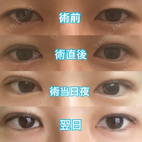 二重埋没 A CLINIC（エークリニック） 銀座院 AFTER