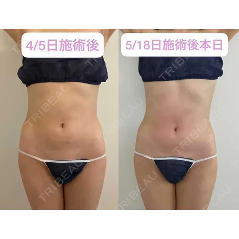 インディバ（腰） Medical Indiba Salon KMK【脂肪吸引後ダウンタイム専門サロン】 AFTER