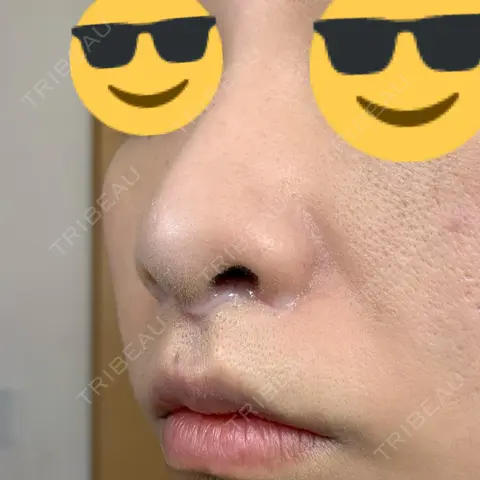 小鼻縮小（切開） / 人中短縮 / 鼻翼挙上 Otus Clinic 【オータスクリニック】 AFTER