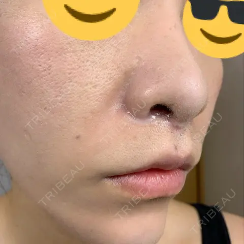 小鼻縮小（切開） / 人中短縮 / 鼻翼挙上 Otus Clinic 【オータスクリニック】 AFTER