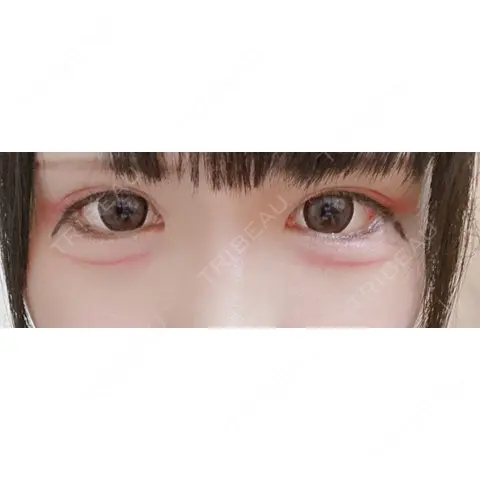 目尻切開 / タレ目形成・グラマラスライン（切開） 東京美容医療クリニック 池袋院 AFTER