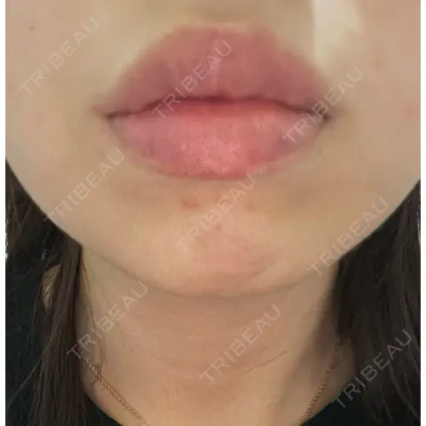 ボトックス（あご） M.CLINIC DAY 0