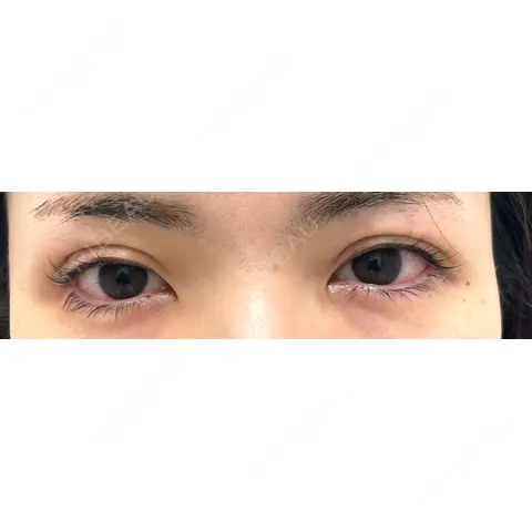 二重埋没 NARU Beauty Clinic 【ナルクリ】 DAY 0