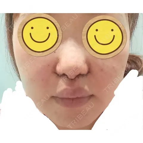 小鼻縮小（切開） / 鼻翼挙上 / 鼻孔縁挙上 / 鼻柱下降・鼻唇角形成（猫手術） Otus Clinic 【オータスクリニック】 DAY 0