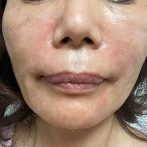 PRP皮膚再生療法 ノリス美容クリニック DAY 0