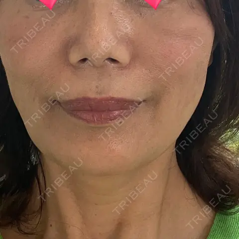 PRP皮膚再生療法 ノリス美容クリニック AFTER