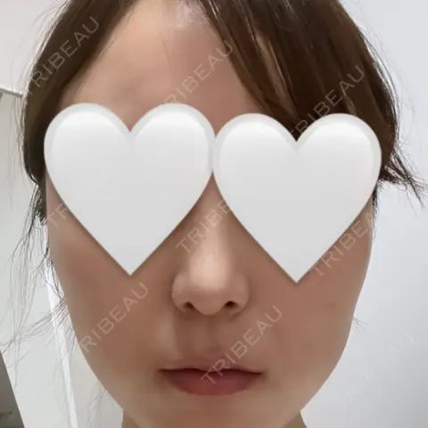 軟骨移植 / 鼻尖縮小 ASTRA BEAUTY CLINIC AFTER