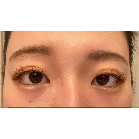 クマ治療 NARU Beauty Clinic 【ナルクリ】 DAY 1