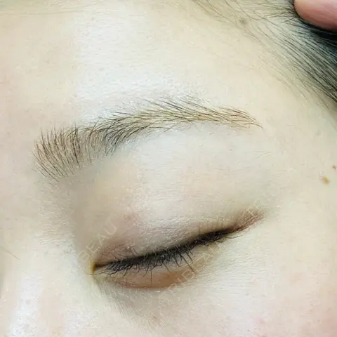 ほくろ・いぼ除去レーザー（肌） 心斎橋形成外科スキンケアクリニック AFTER