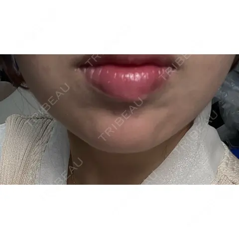 ボトックス（あご） M.CLINIC AFTER