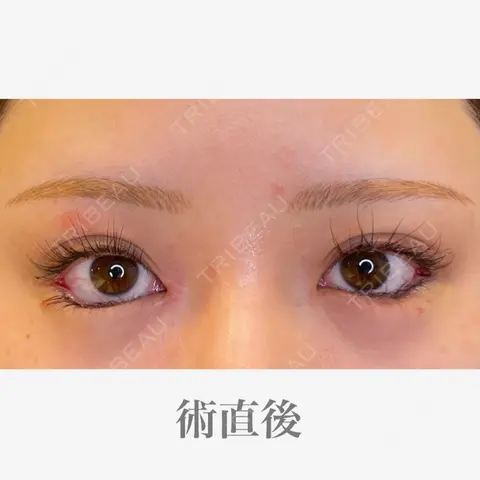 目尻切開 / タレ目形成・グラマラスライン（埋没） LOUIS CLINIC 二子玉川院【ルイクリニック】 DAY 0